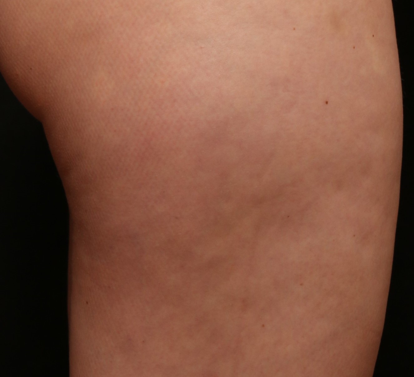 Post Aveli after photo - Right Lateral Thigh