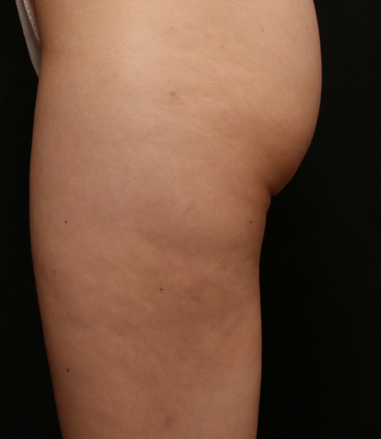 6 month post Avali (1)