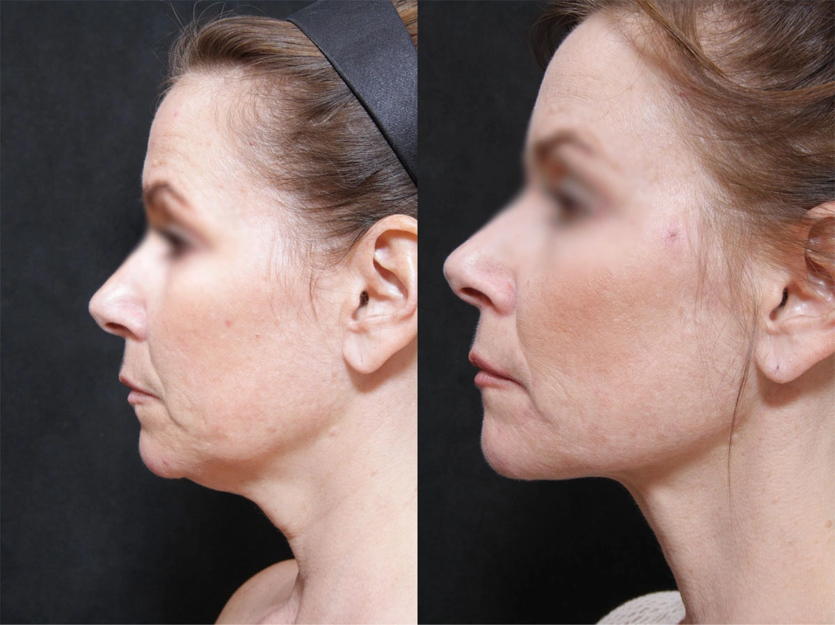 Real patient results before and after plastic surgery results in Glenview, IL, performed by Dr. Casas
