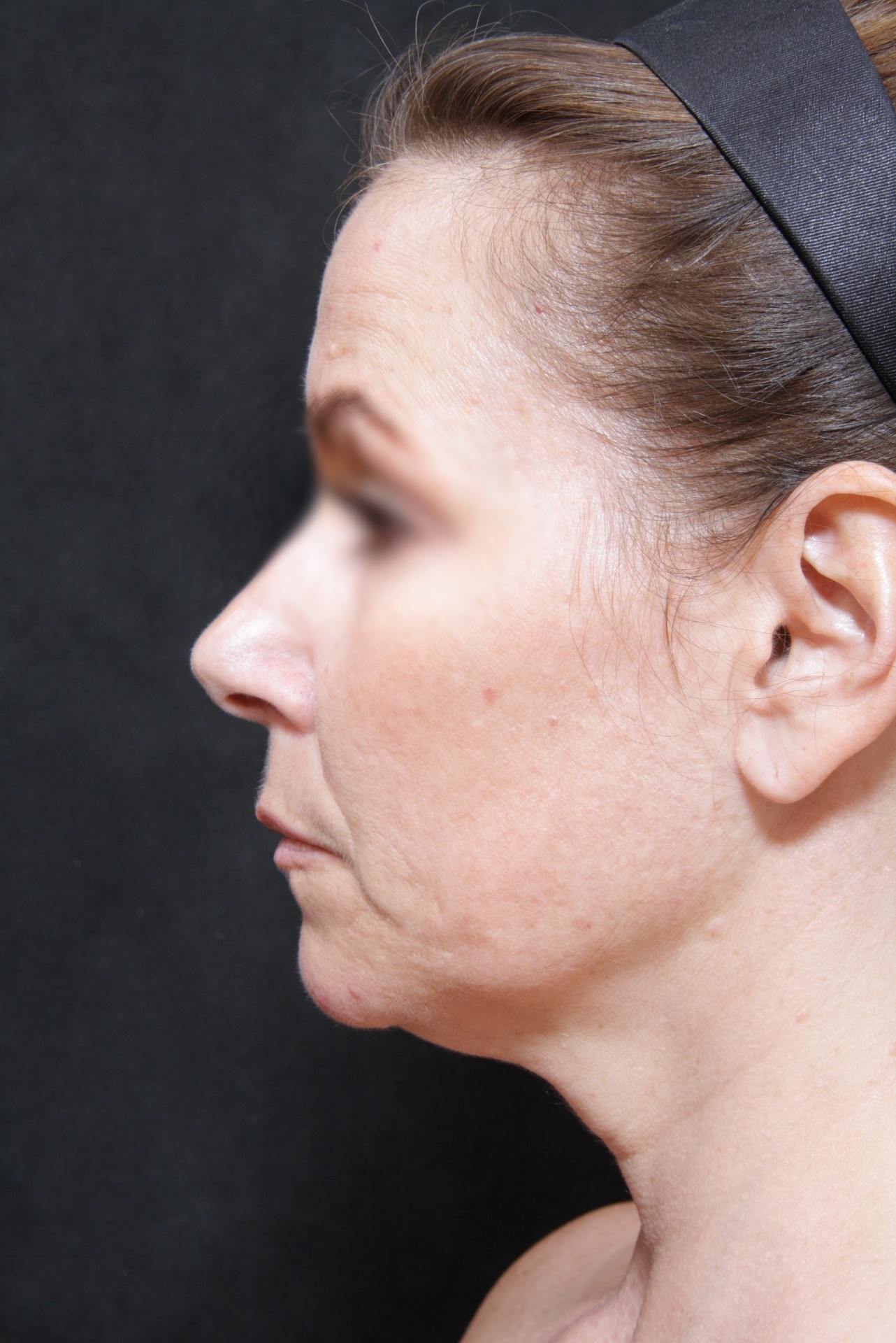 Real patient results before and after plastic surgery results in Glenview, IL, performed by Dr. Casas