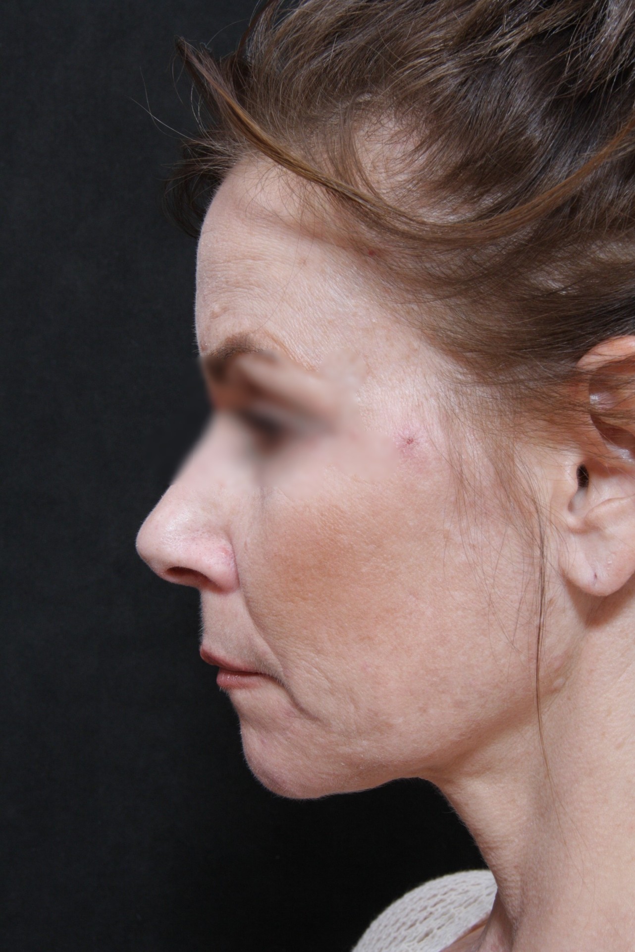 Real patient results before and after plastic surgery results in Glenview, IL, performed by Dr. Casas