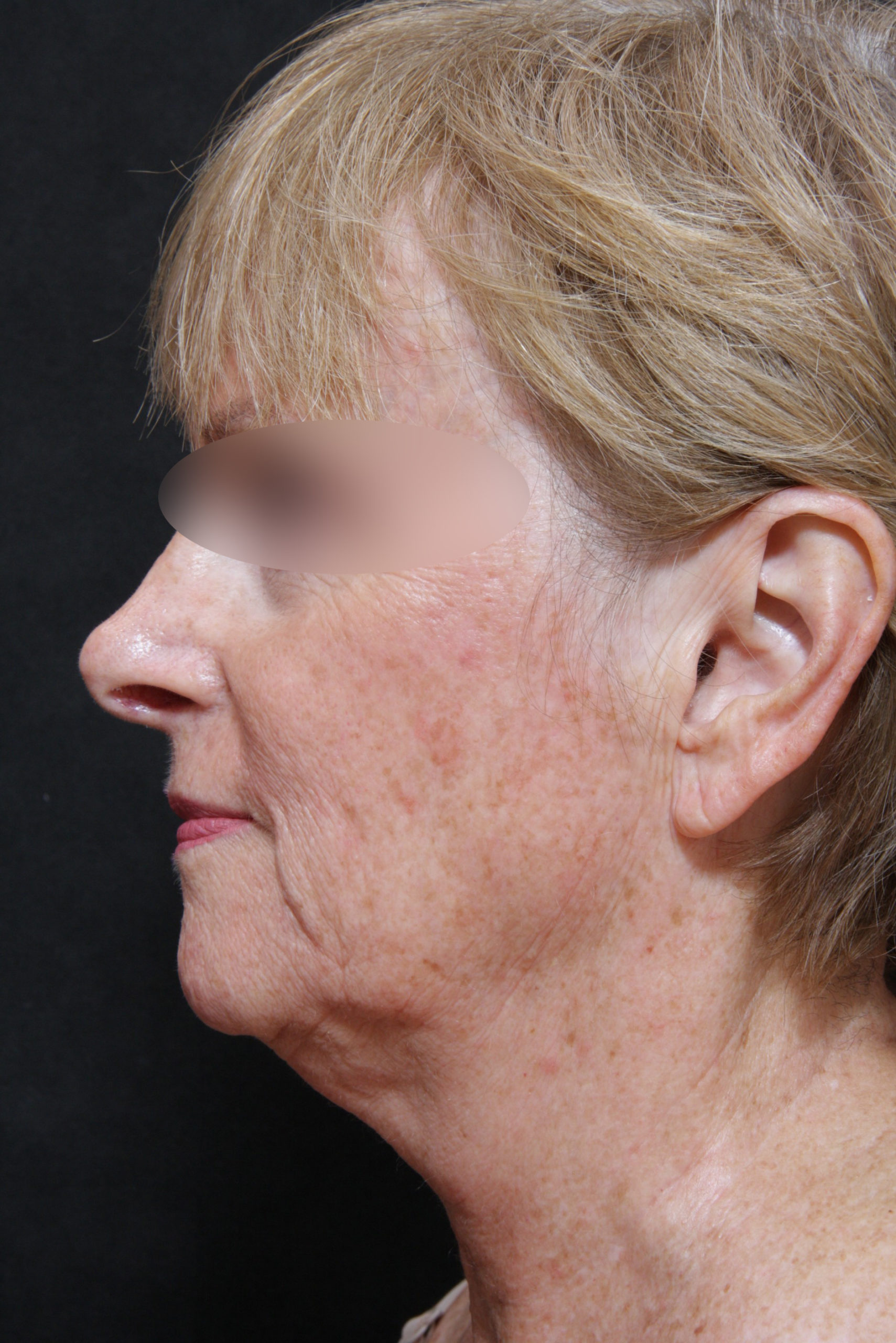 Real patient results before and after plastic surgery results in Glenview, IL, performed by Dr. Casas