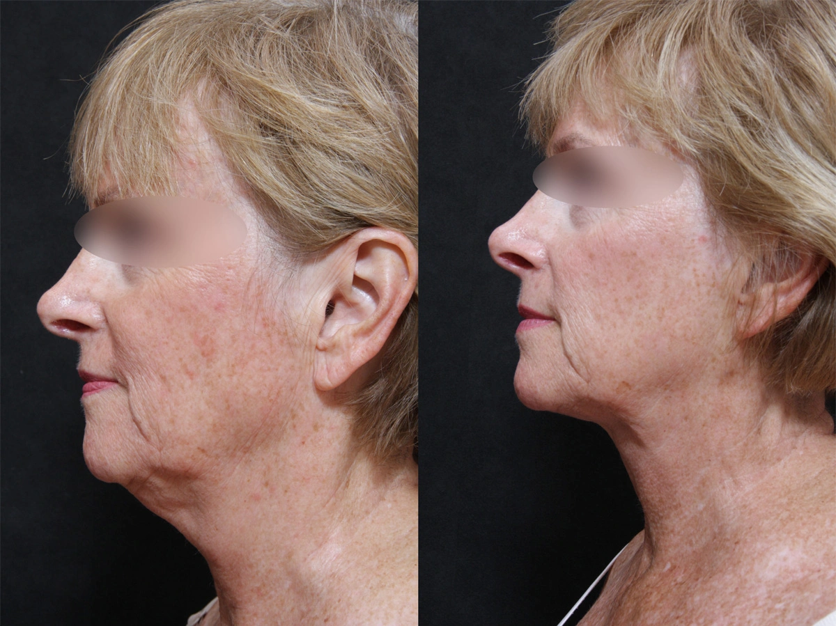 Real patient results before and after plastic surgery results in Glenview, IL, performed by Dr. Casas
