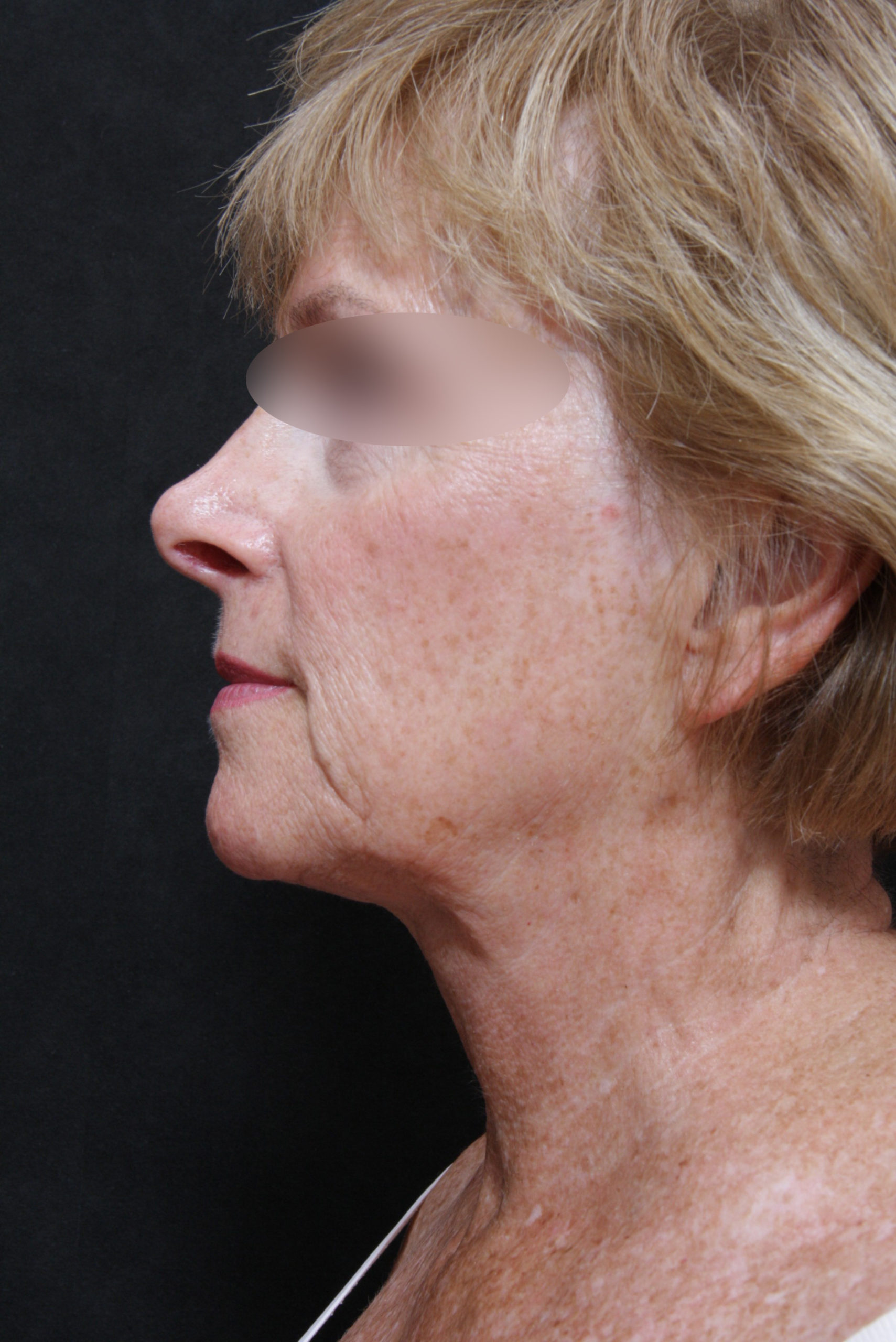 Real patient results before and after plastic surgery results in Glenview, IL, performed by Dr. Casas