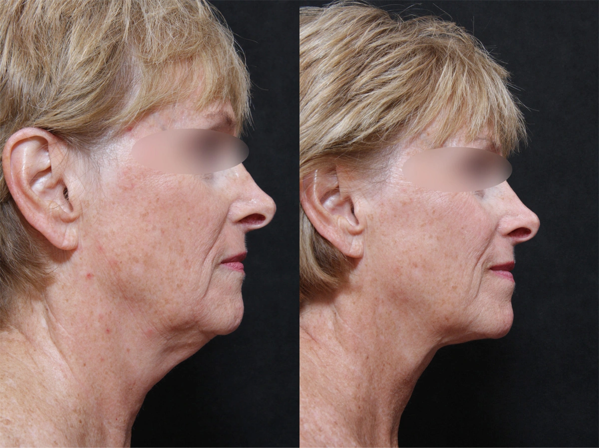 Real patient results before and after plastic surgery results in Glenview, IL, performed by Dr. Casas