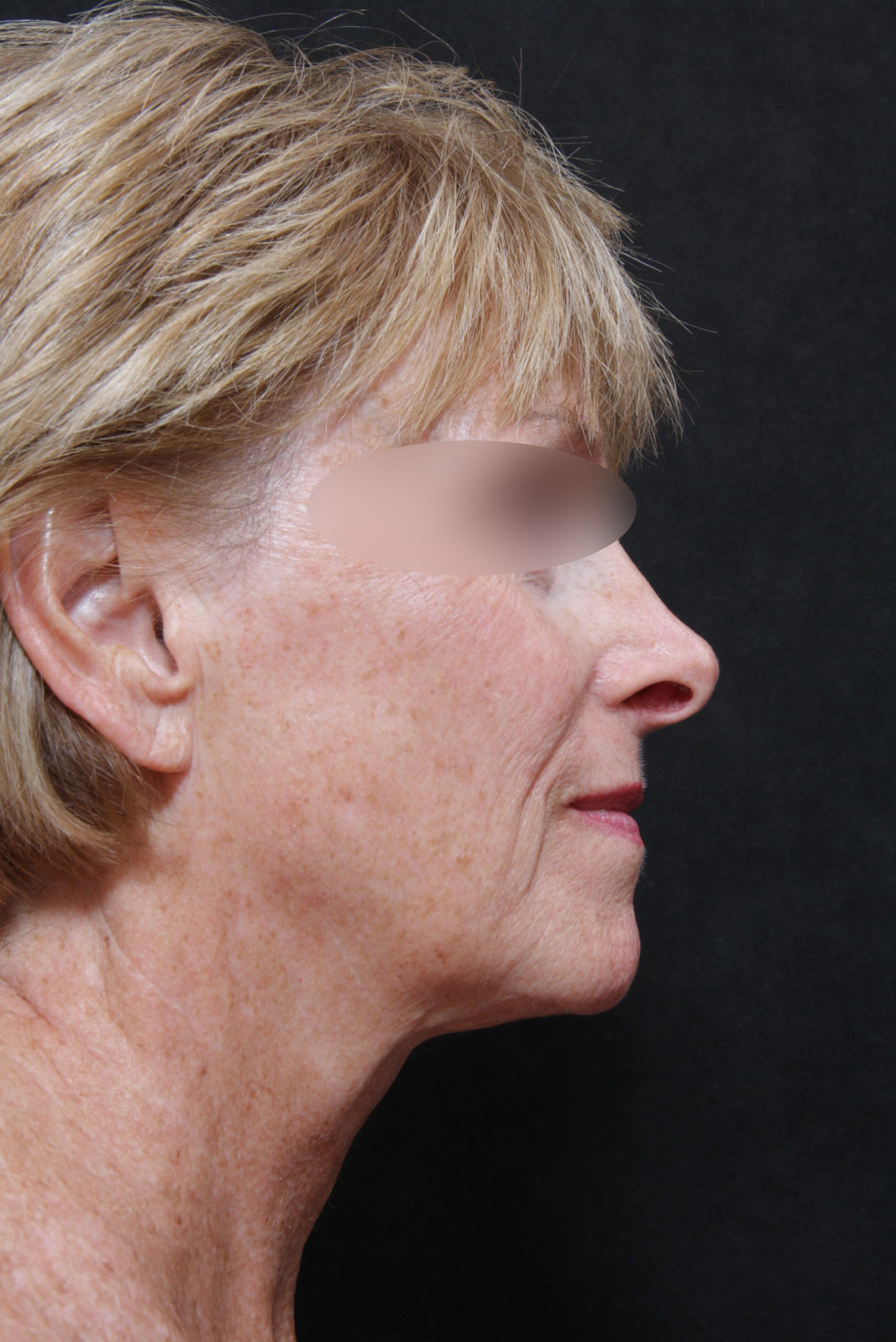Real patient results before and after plastic surgery results in Glenview, IL, performed by Dr. Casas