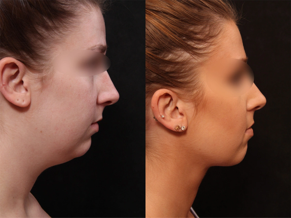 Real patient results before and after plastic surgery results in Glenview, IL, performed by Dr. Casas