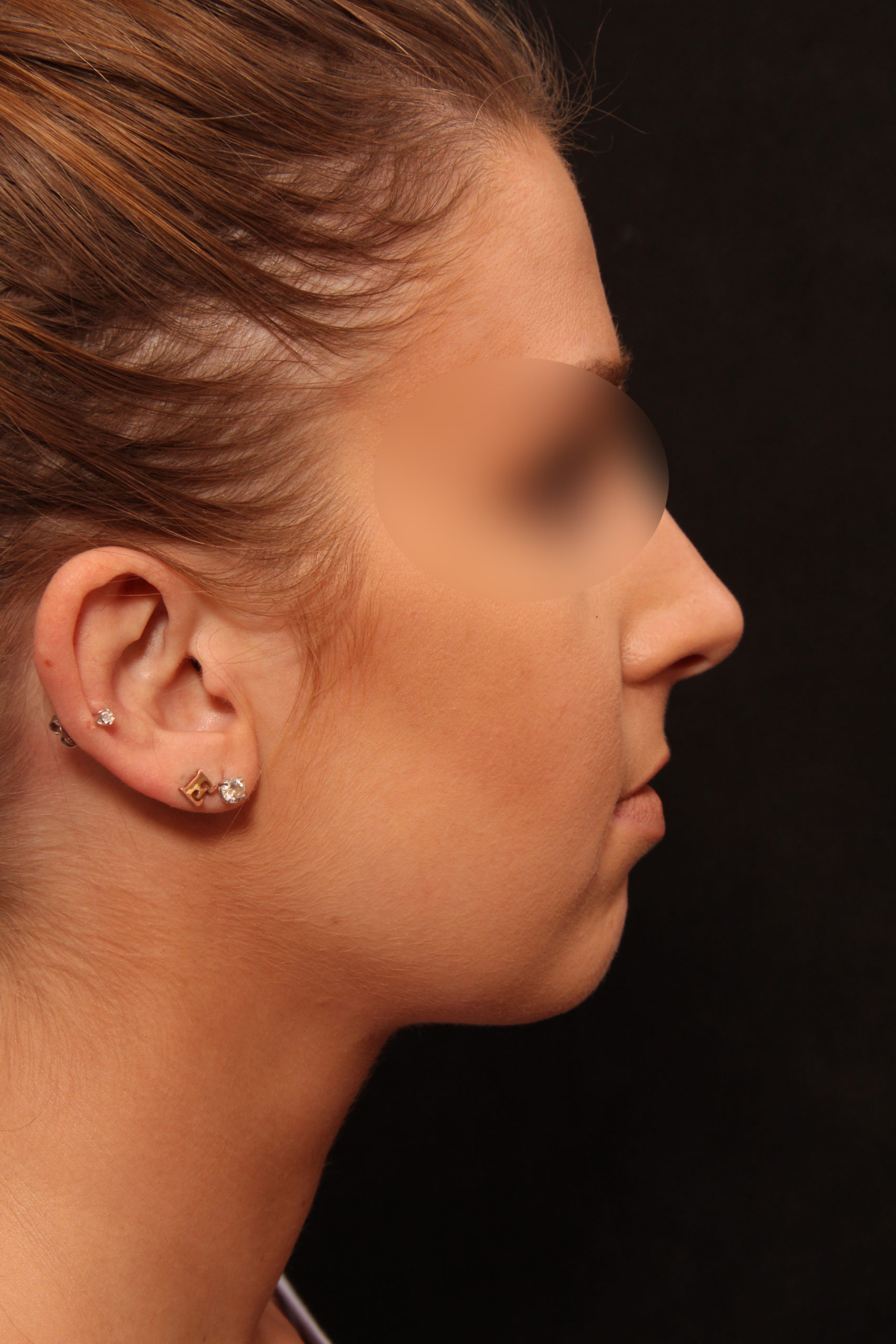 Real patient results before and after plastic surgery results in Glenview, IL, performed by Dr. Casas
