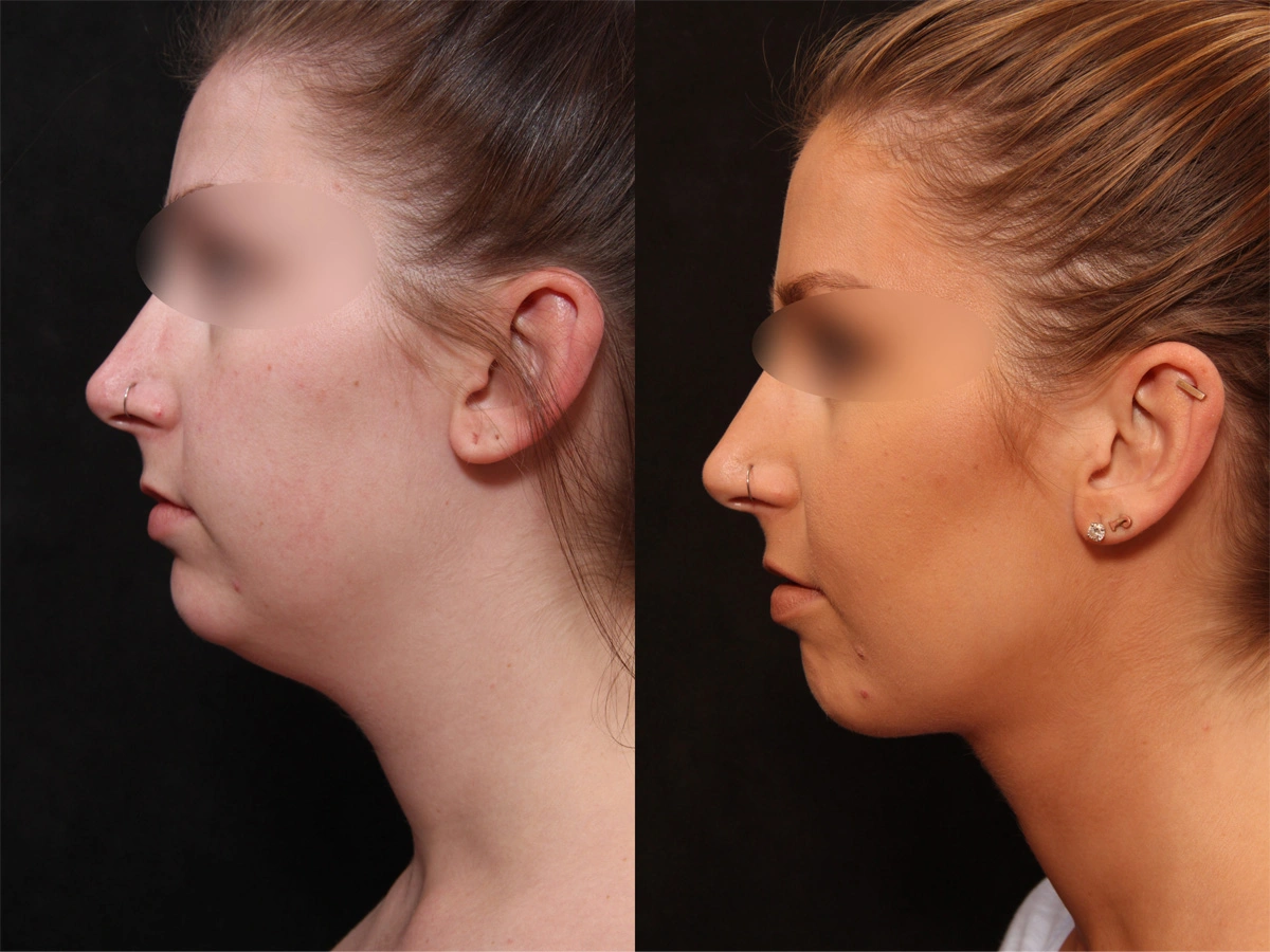 Real patient results before and after plastic surgery results in Glenview, IL, performed by Dr. Casas
