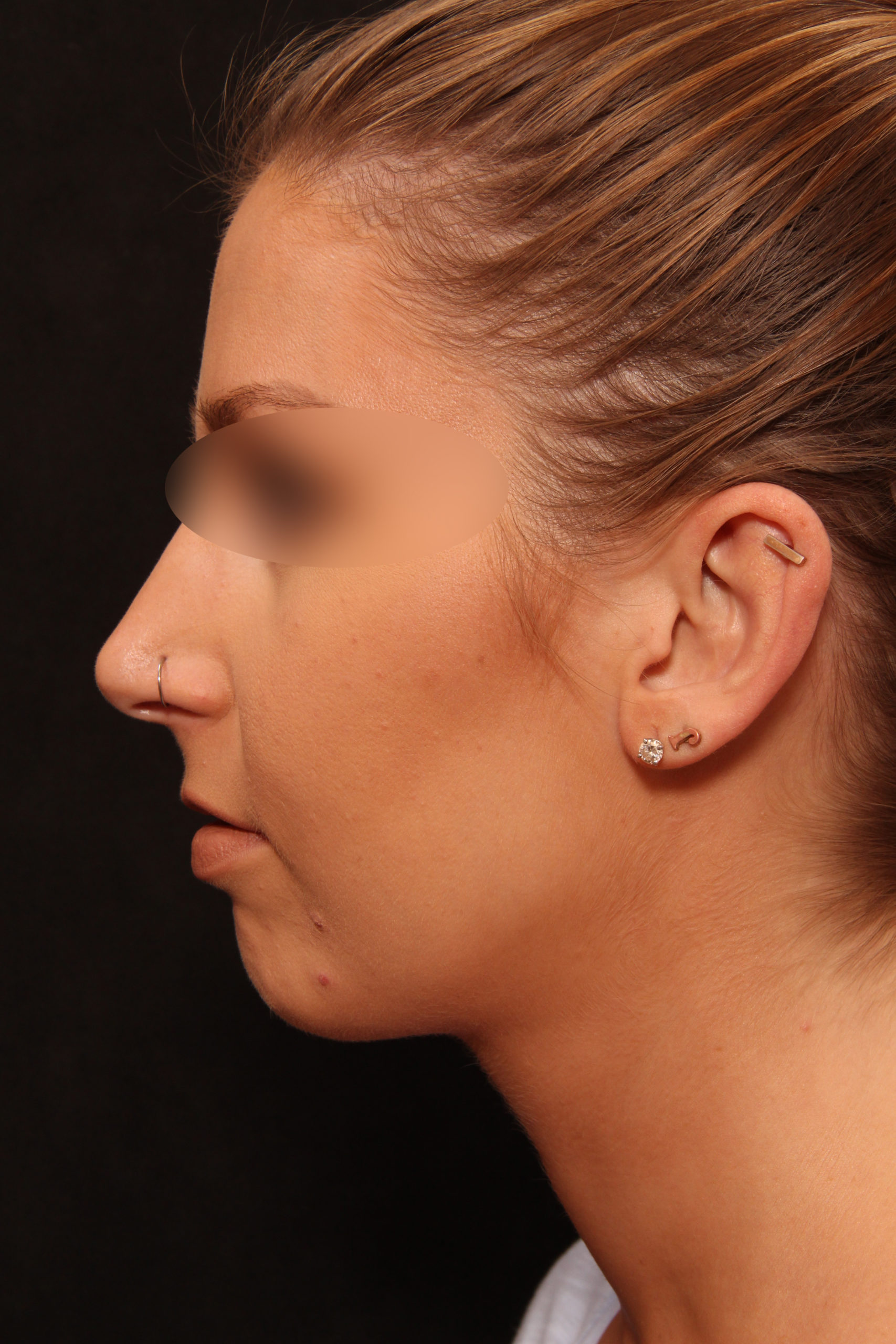 Real patient results before and after plastic surgery results in Glenview, IL, performed by Dr. Casas