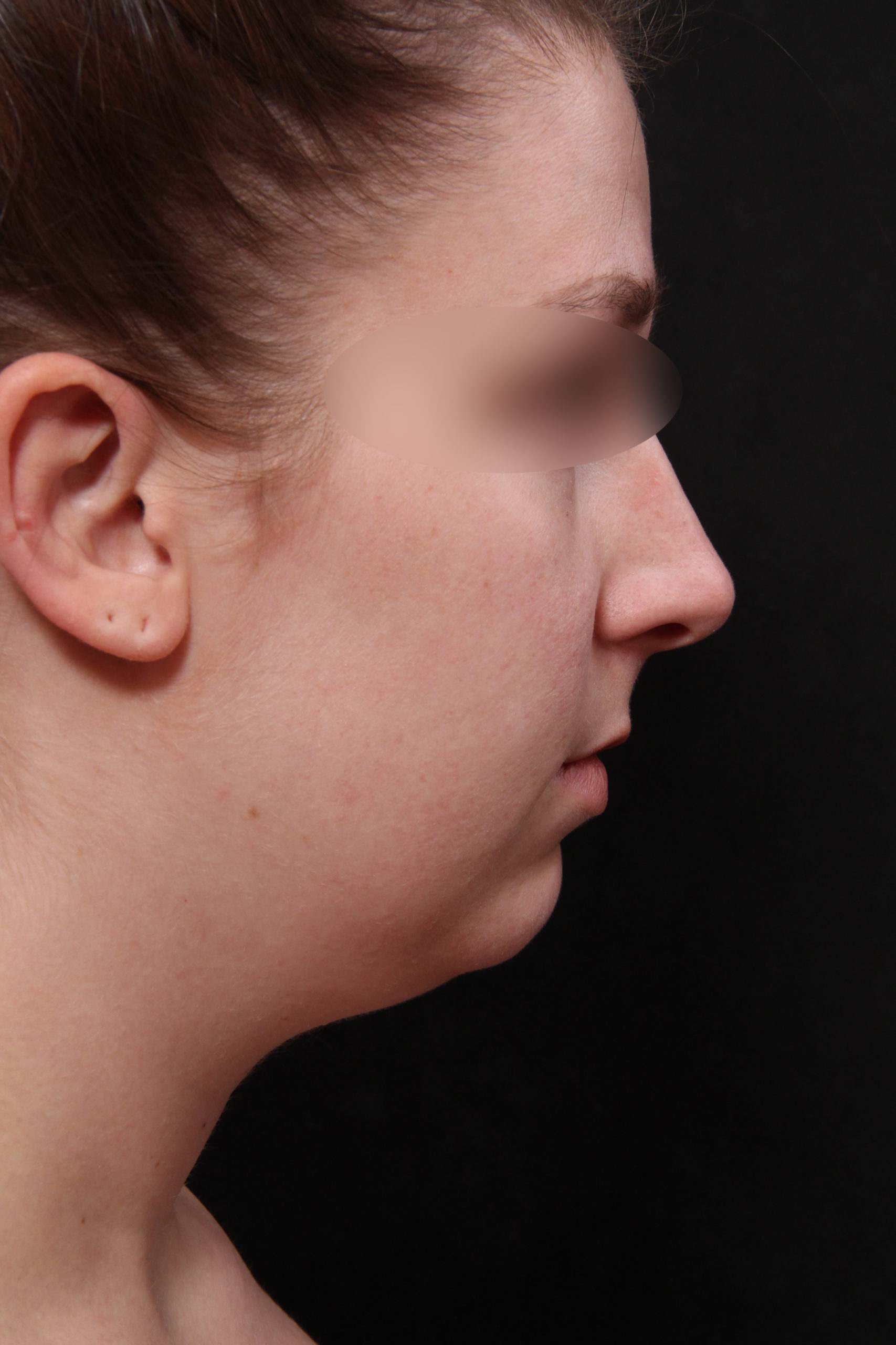 Real patient results before and after plastic surgery results in Glenview, IL, performed by Dr. Casas