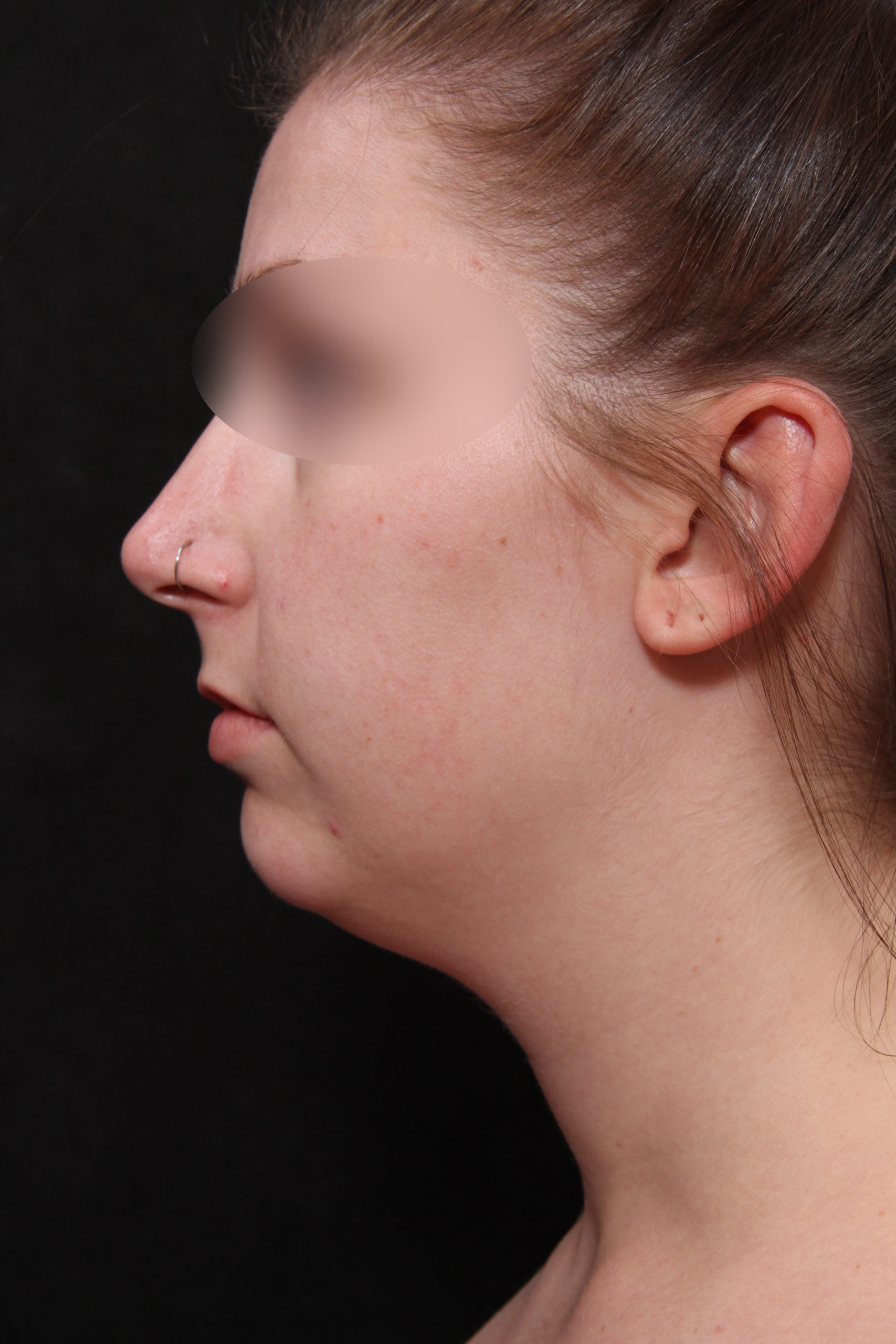 Real patient results before and after plastic surgery results in Glenview, IL, performed by Dr. Casas