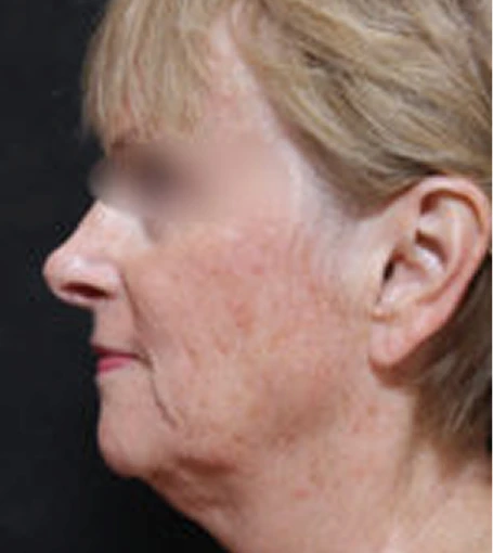 Real patient results before and after plastic surgery results in Glenview, IL, performed by Dr. Casas