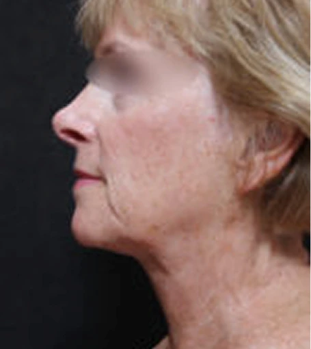 Real patient results before and after plastic surgery results in Glenview, IL, performed by Dr. Casas