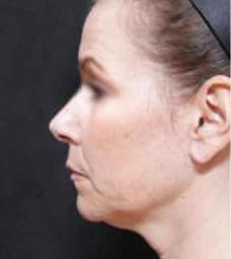 Real patient results before and after plastic surgery results in Glenview, IL, performed by Dr. Casas