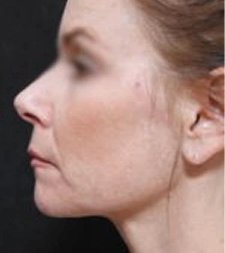 Real patient results before and after plastic surgery results in Glenview, IL, performed by Dr. Casas