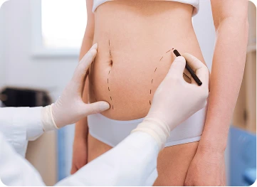 Doctor marking abdomen for liposuction or cosmetic surgery consultation with patient in medical clinic