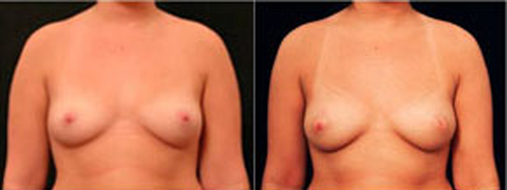 Real patient results before and after plastic surgery results in Glenview, IL, performed by Dr. Casas