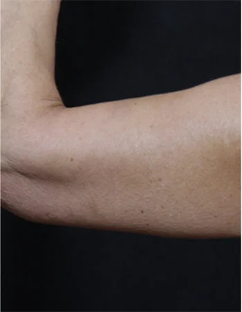 Relaxed arm showing natural skin texture against black background