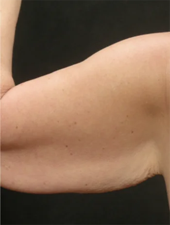 Relaxed arm showing natural skin texture and tone against dark background