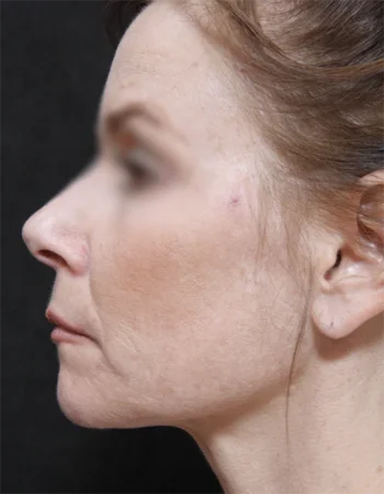 Woman's profile showing smooth facial contours after cosmetic procedure results
