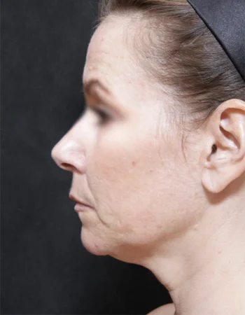 Woman's profile showing facial features and neck contour against dark background for aesthetic assessment