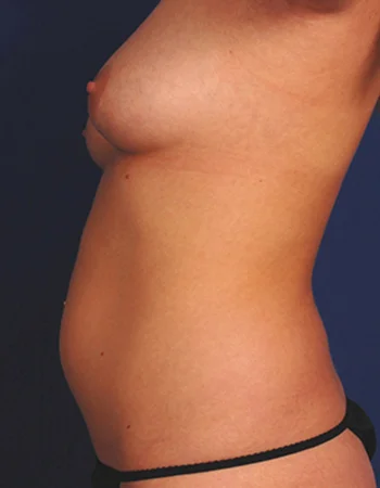 Female torso side view showing slim body contour after cosmetic procedure