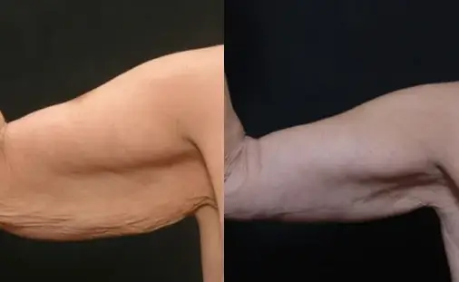 armlift